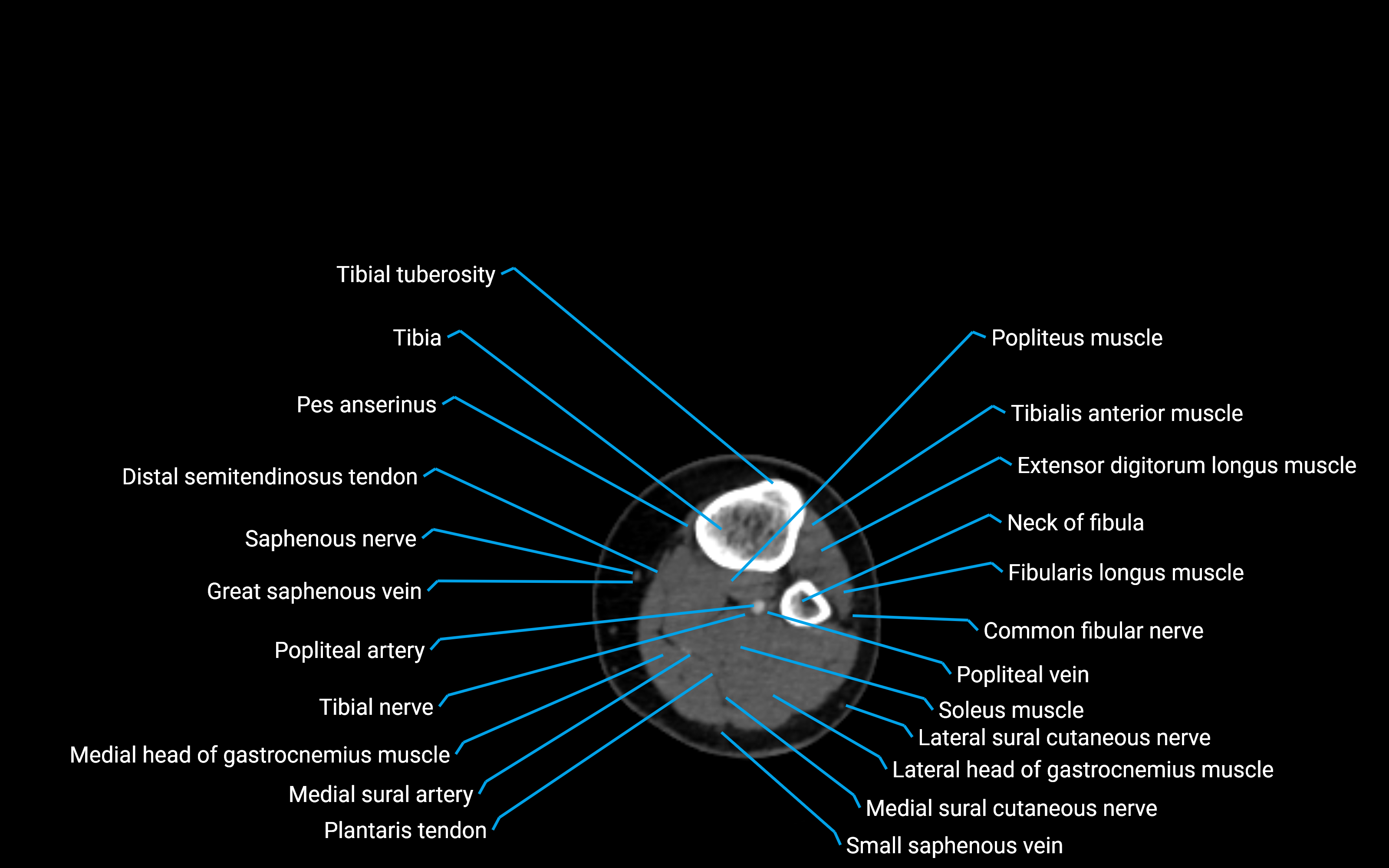 CT Lower leg axial cross sectional anatomy labelled image 99 (2).png